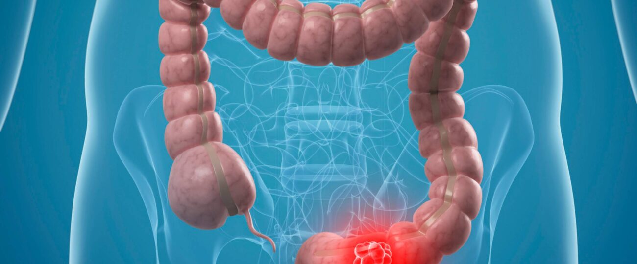 आन्द्राको क्यान्सर : के तपाईको पेट पनि बारम्बार दुखी राख्छ ? होशियार