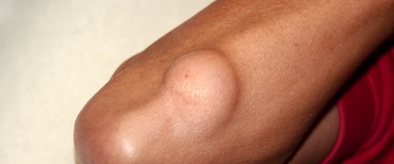 के तपाईको शरिरमा पनि सानो सानो मासुको डल्लो छ ? यस्तो हुनसक्छ कारण