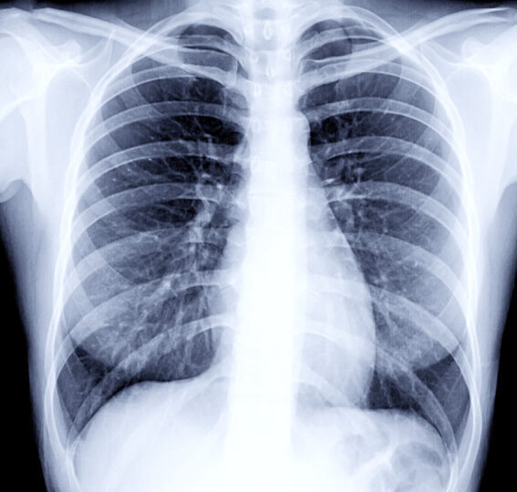 छातीमा देखिने दाग भनेको के हो ? जान्नुहोस्